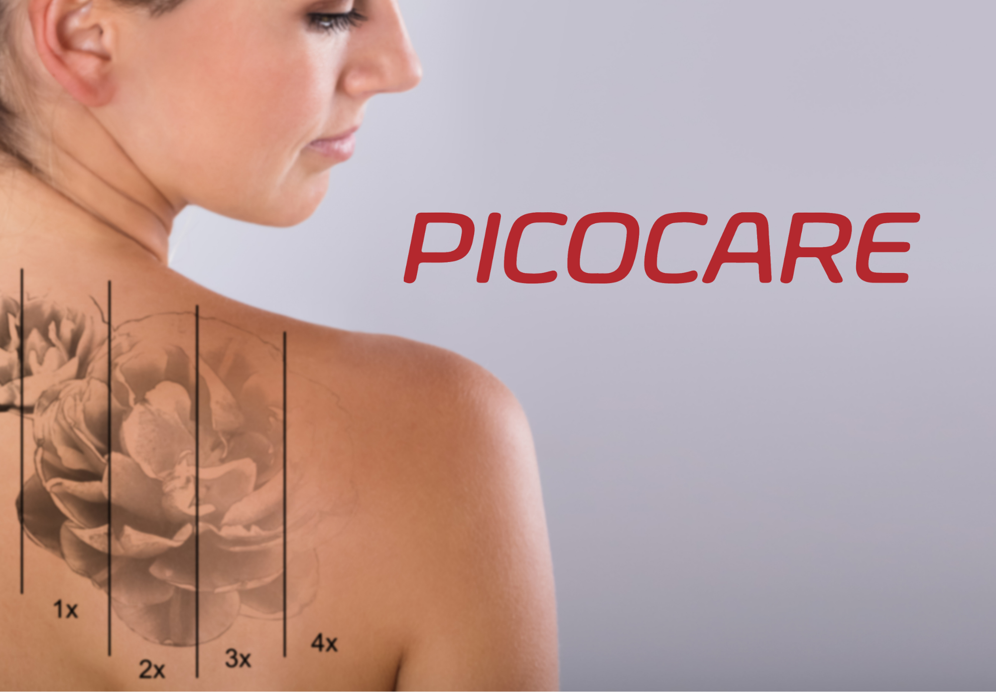 Tattoo removal with PicoCare Laser system.